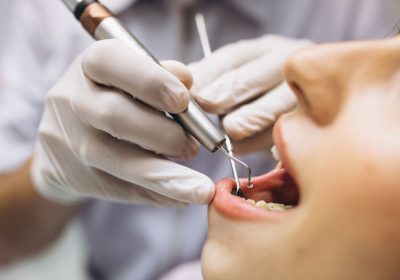 Tooth Extraction: Understanding the Procedure, Cost, and Recovery
